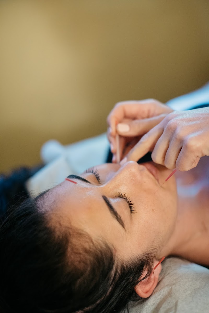 SF Holistic Medicine Acupuncture, Dry Needling, Cosmetic Acupuncture + Microneedling & Functional Medicine photo 5