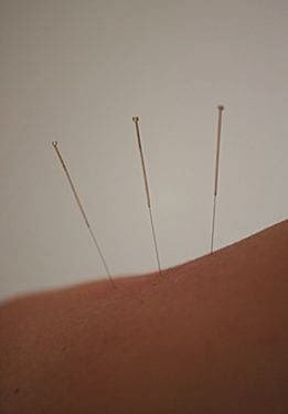 Alaska Acupuncture photo 5